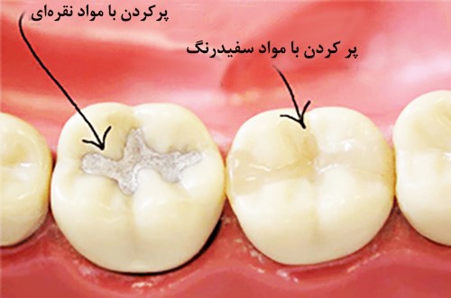 پركردن دندان با مواد مخصوص