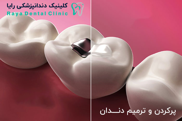 پركردن دندان-Dental Fillings