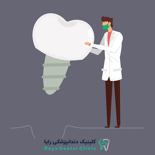 کاشت دندان بدون ایمپلنت