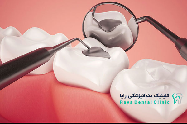 پر کردن دندان