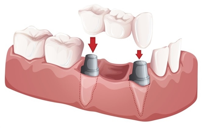 انواع بریج