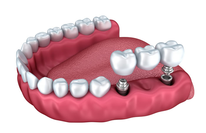 ایمپلنت متحرک چیست؟