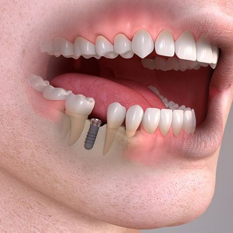 فیکسچر در ایمپلنت