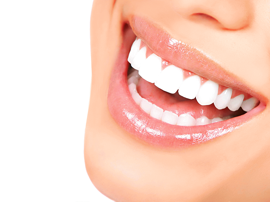 لمینت دندان چیست؟