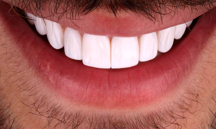 مزایا بی حسی موضعی