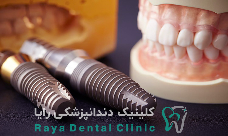 قیمت ایمپلنت