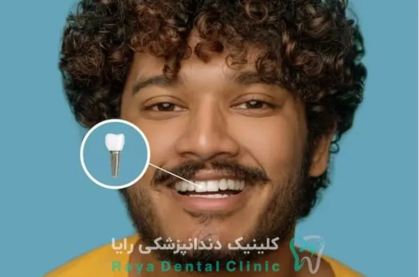 مراقبت های بعد از ایمپلنت دندان