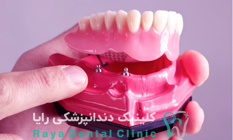 دندان مصنوعی یا ایمپلنت دندان