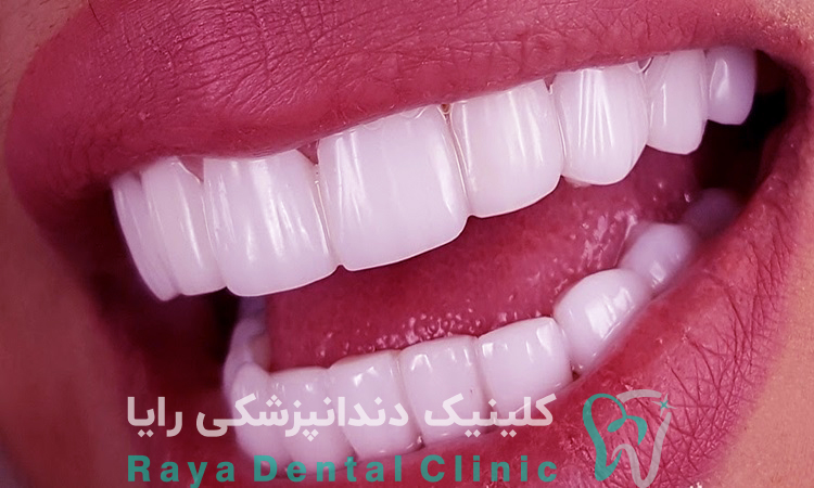 لبخند هالیوودی