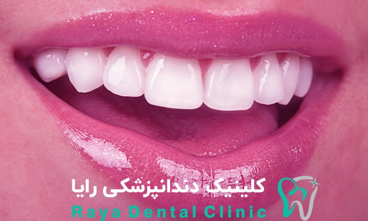 لمینت دندان چیست؟