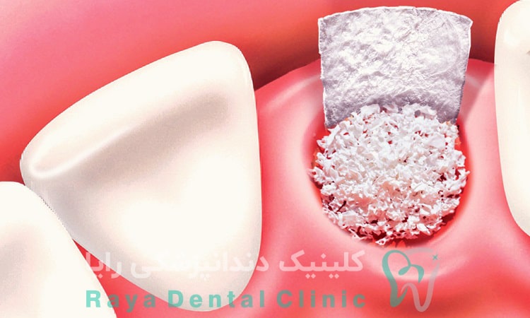 پیوند استخوان برای ایمپلنت