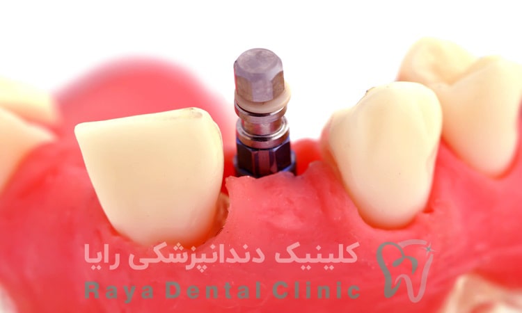 عفونت ایمپلنت دندان