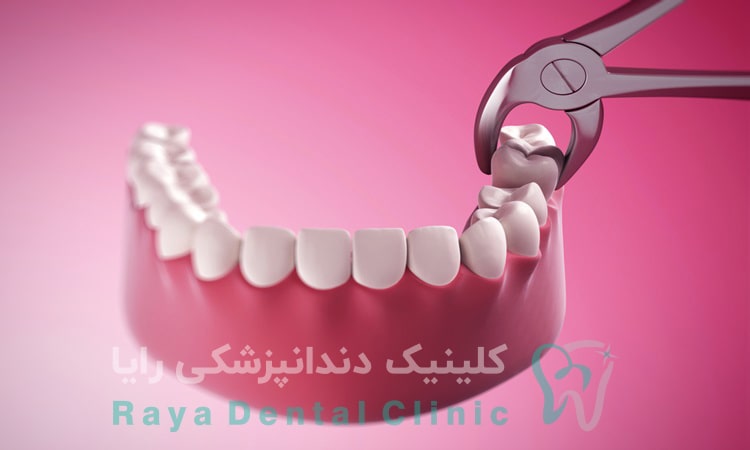 درد دندان عقل