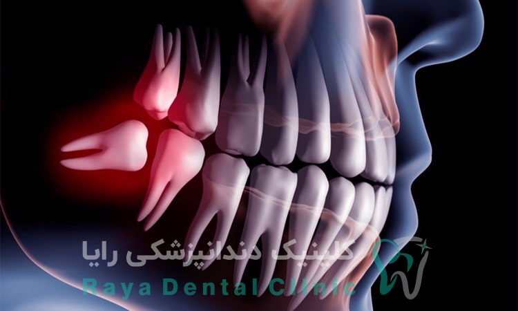 جراحی دندان عقل
