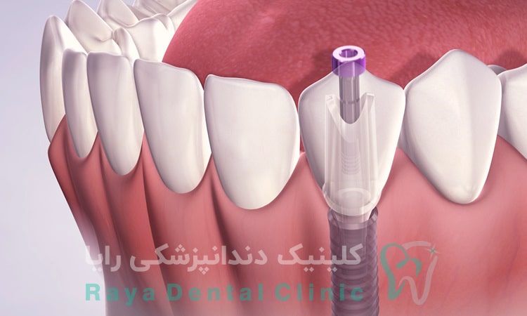  لق شدن ایمپلنت دندان