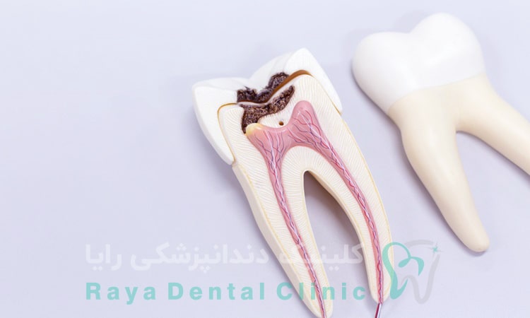 پر کردن دندان