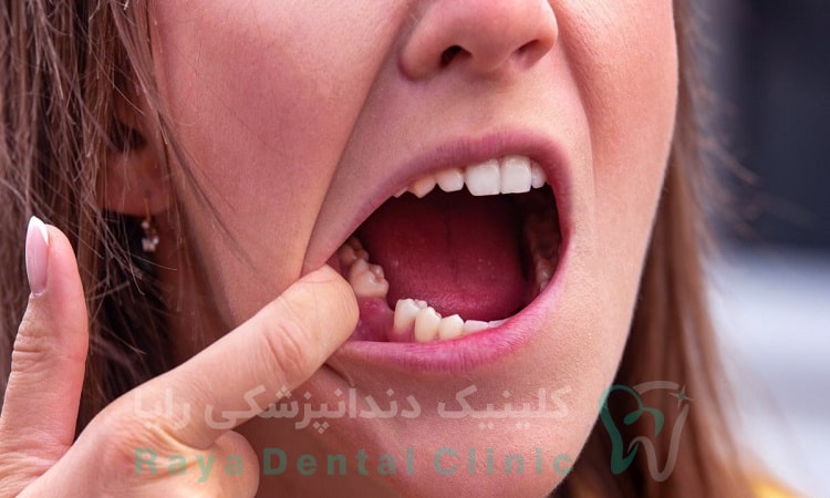 ایمپلنت دندان