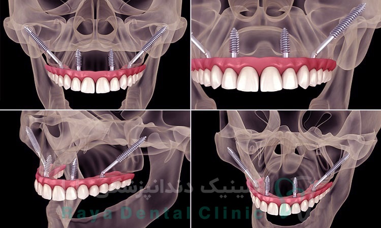 کاربردهای ایمپلنت زیگوماتیک