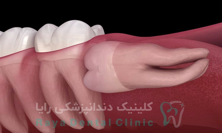 دندان عقل نهفته