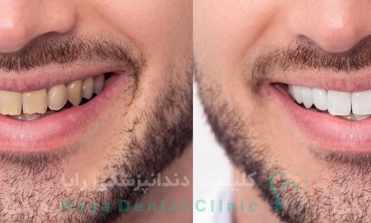 بلیچینگ دندان چیست؟