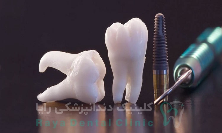 ایمپلنت کره ای یا سوئیسی؟