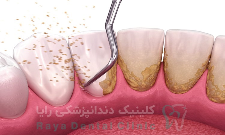 جرم گیری دندان