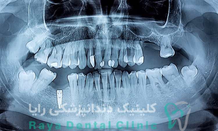 عکس برداری به روش OPG