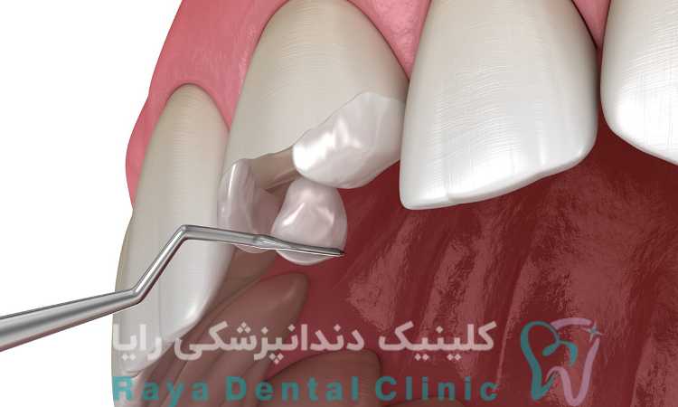 بیلداپ دندان
