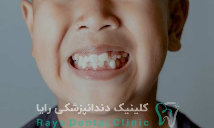 هایپردونتیا چیست؟