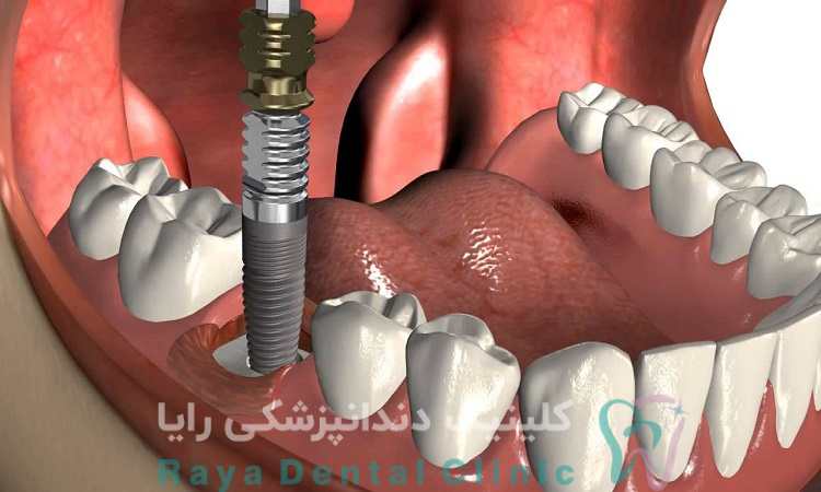 پس زدن ایمپلنت دندان