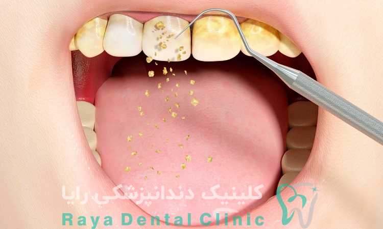 پلاک دندان چیست؟