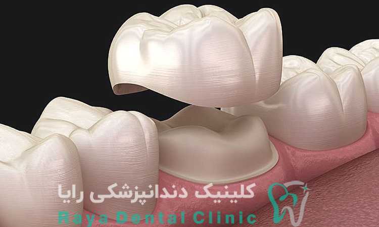 روکش دندان