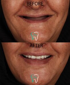 نمونه قبل و بعد لمینت دندان