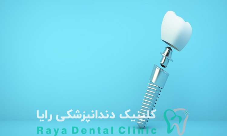 ایمپلنت اروپایی