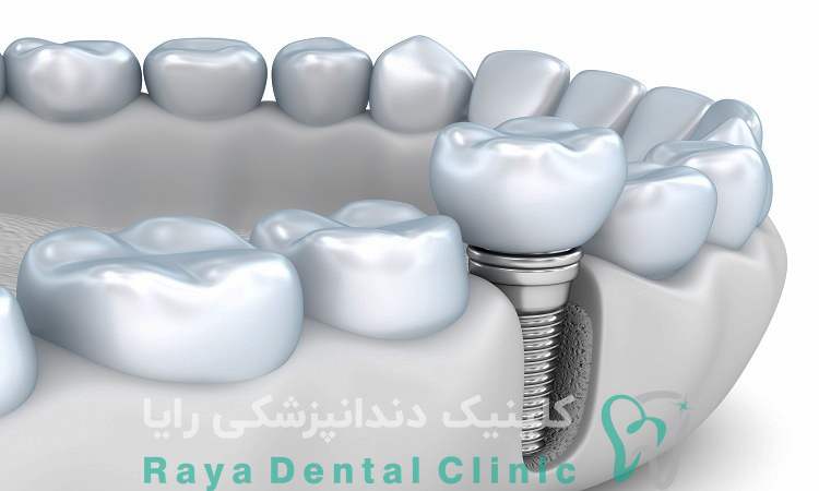 ایمپلنت‌ های اروپایی
