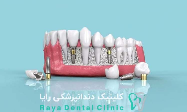 ایمپلنت سوئیسی