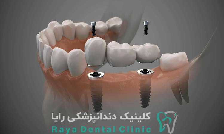 ایمپلنت دندان