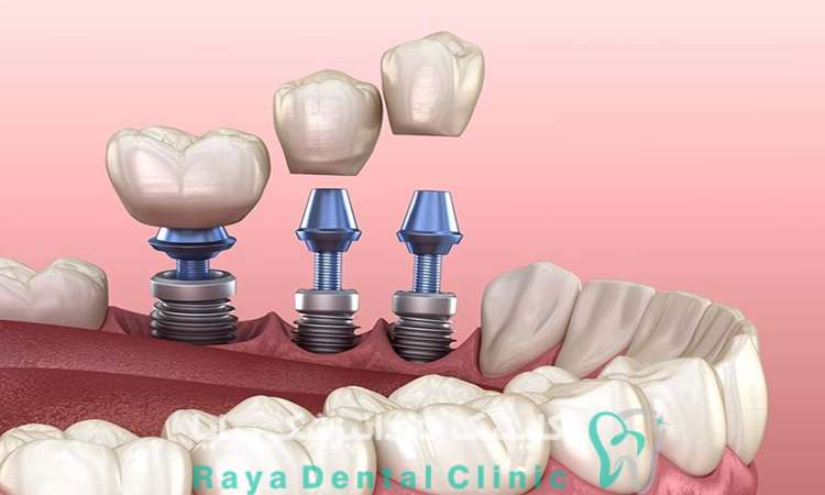 ایمپلنت اشترومن