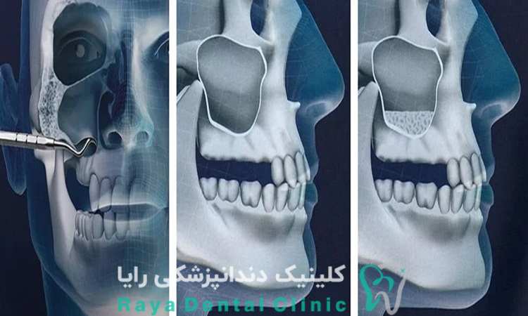 جراحی سینوس لیفت