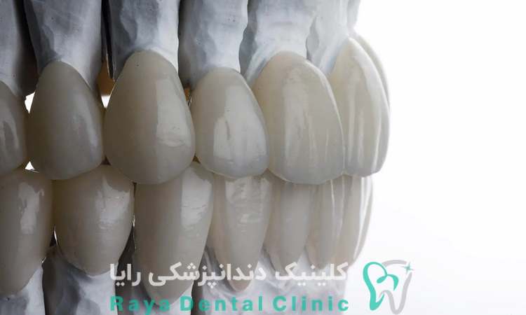 ترندهای کامپوزیت دندان