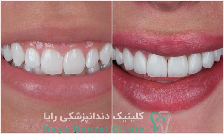 قیمت لمینیت دندان