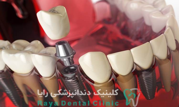 قیمت کاشت دندان