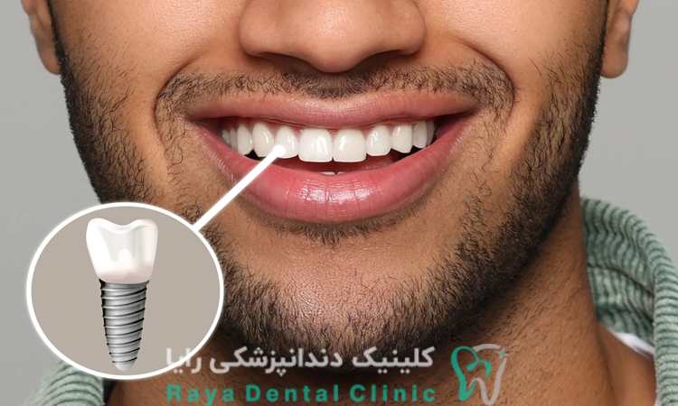 ایمپلنت دندان جلو