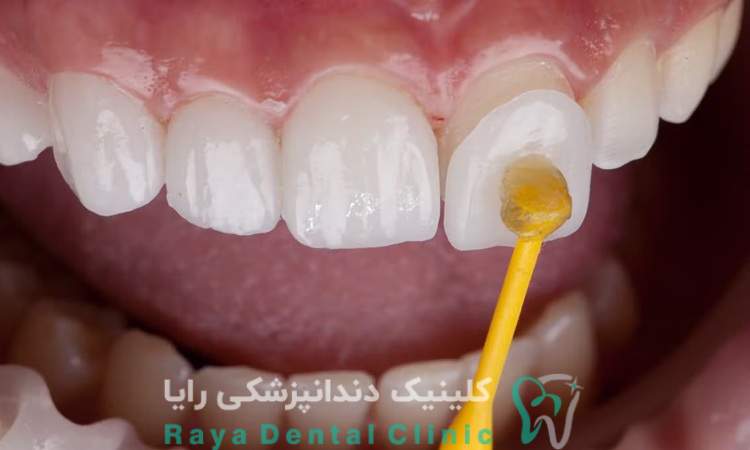 نقش ضخامت لمینیت