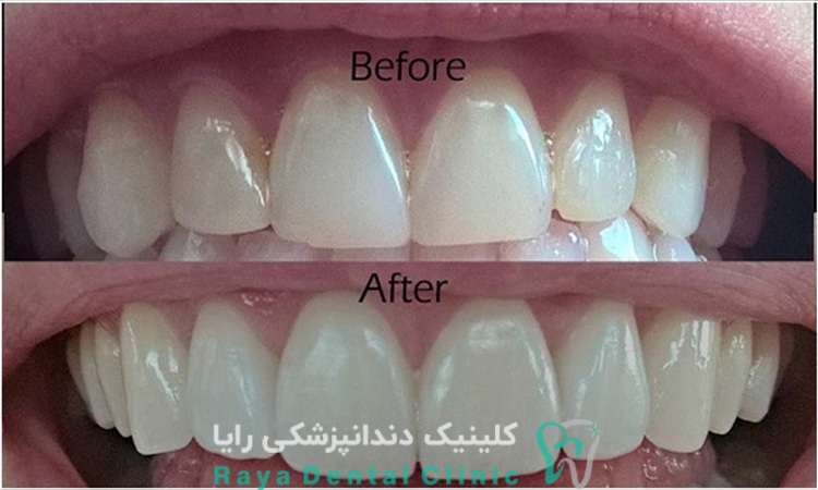 کامپوزیت دندان