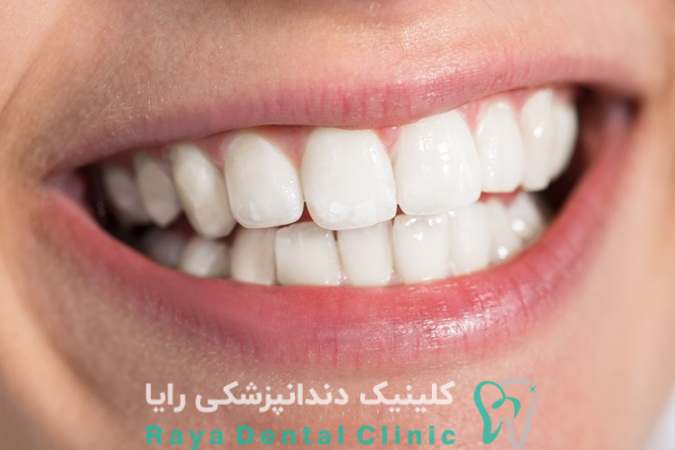 ماندگاری لمینیت دندان