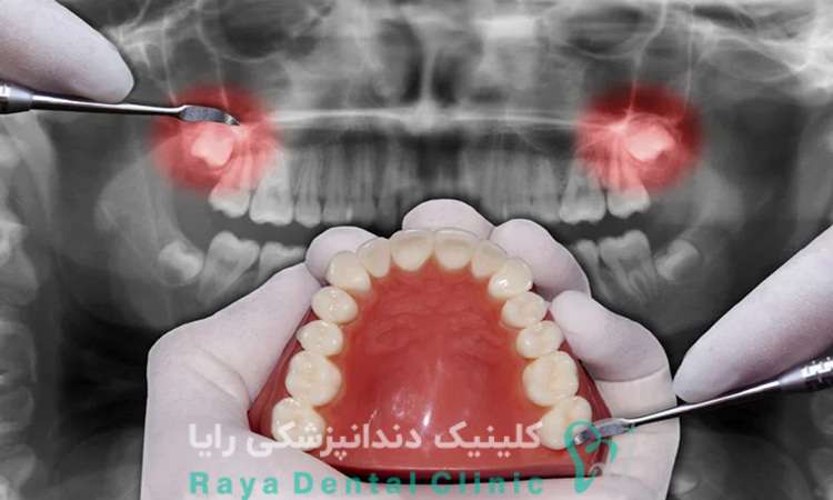 جراحی دندان عقل