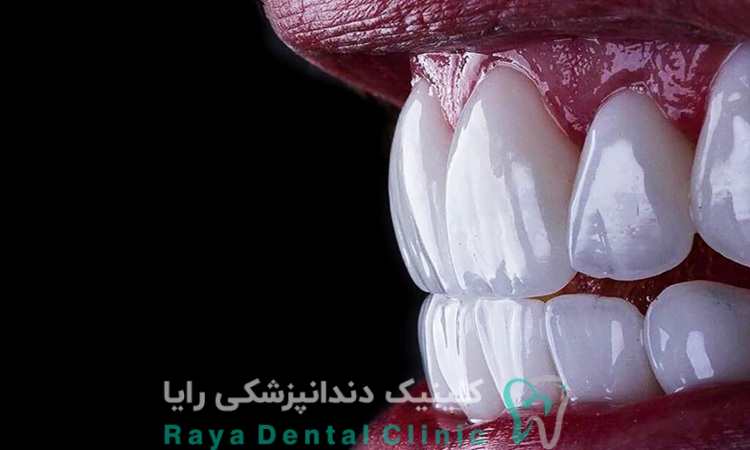 ونیر سرامیکی طبیعی