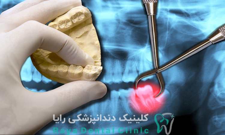 کشیدن دندان عقل جراحی