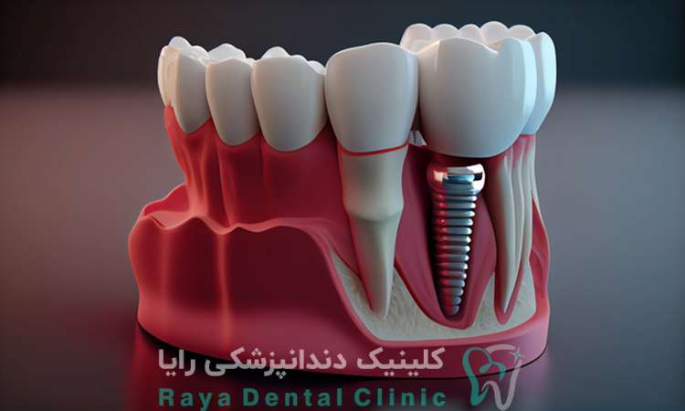بهترین دندانپزشک ایمپلنت
